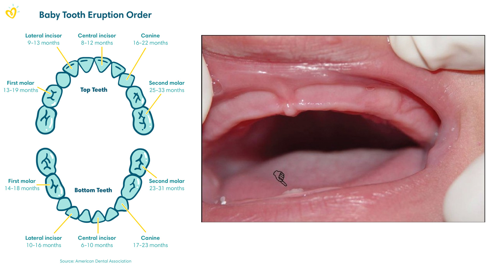 Baby tooth eruption order